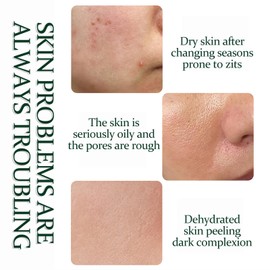 Tea Tree Zits Cream 50g - Cream With Oil Control, Soothing & Moisturizing - Improve Zits & Blemishes - Clearer Skin Solution