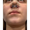 Nostril Retainer (2 Pack – Different Sizes) | Nose Splint