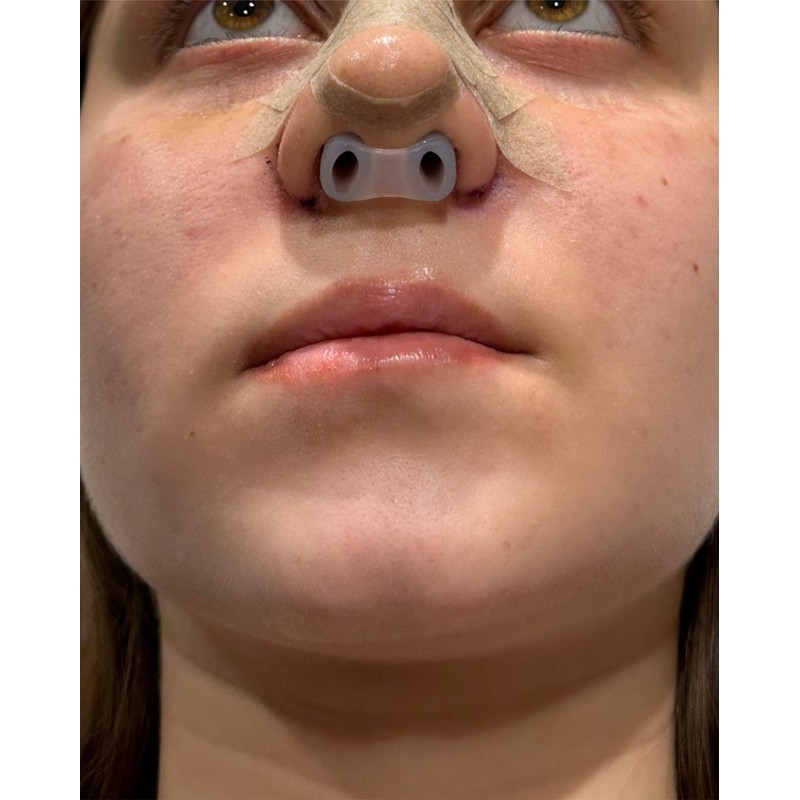 Nostril Retainer (2 Pack – Different Sizes) | Nose Splint
