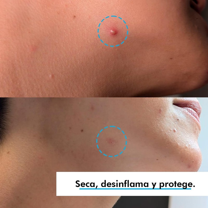 Simple Pimple - Pickel Pflaster, Pimple Patches mit Salicylsäure, Teebaumöl,