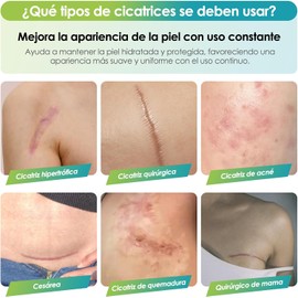 Parches de Silicona para Cicatrices, Láminas de Silicona Reutilizables para Reducir la Apariencia de Cicatrices, Cesárea, Cirugía, Acné y Estrías, Suaves y Transpirables