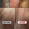 Crema Remove Verrugas,elimina Verrugas Corporales Y Faciales
