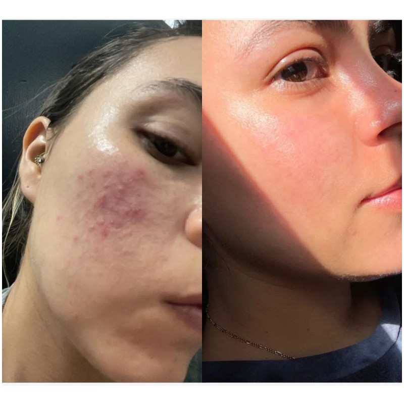 Sialbé Kit Skincare Antiacné Con Ácido Salicílico