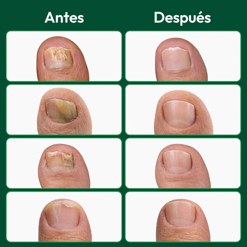 Z Parches Verdora Para Uñas Dañadas, Reparación De 16 /