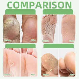 3 Pairs Foot Peel Mask For Hard Skin,Foot Peel Mask,Fo-Ot M-Asks Remove Hard Skin,Moisturizing And Nourishing,Softening,Non-Irritating,Repairing Feet Socks,For Cracked Heel,Dead&Dry Feet(Aloe Vera)