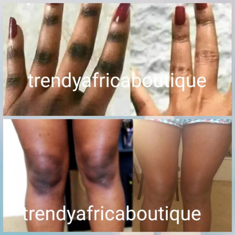 TRENDY Glitzluxury Double Action Knuckles, Elbows, Knees, Armpit Cream👌50ml X1.