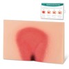 MedEduQuest Decubitus Ulcer Wound Care Model, Bedsores Model, Pressure Injury