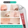 Electric Facial Blackhead Cleansing Vacuum Suction Machine with 20X 5MP