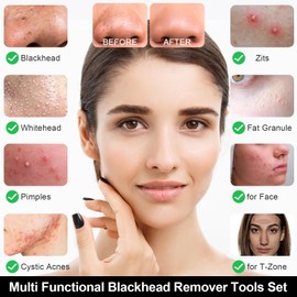 Fangze Blackhead Remover Tool Kit - 6 Pcs Pimple Popper Tool Set Professional Pimple Extractor Tweezers for Face Nose Acne Ingrown Hair (Black)