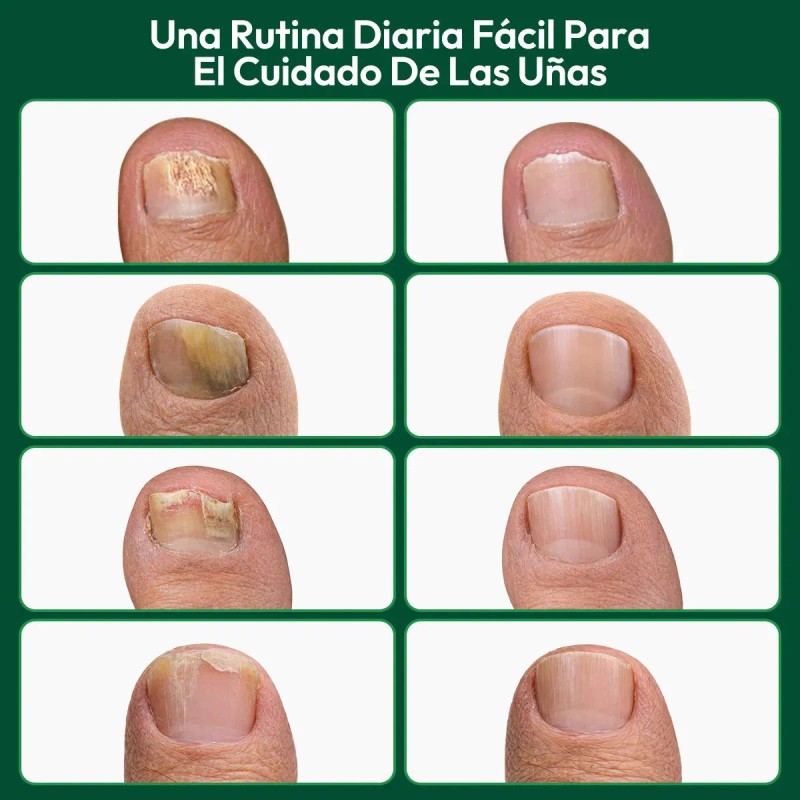 Z Parches Verdora Para Uñas Dañadas, Reparación De 16 /