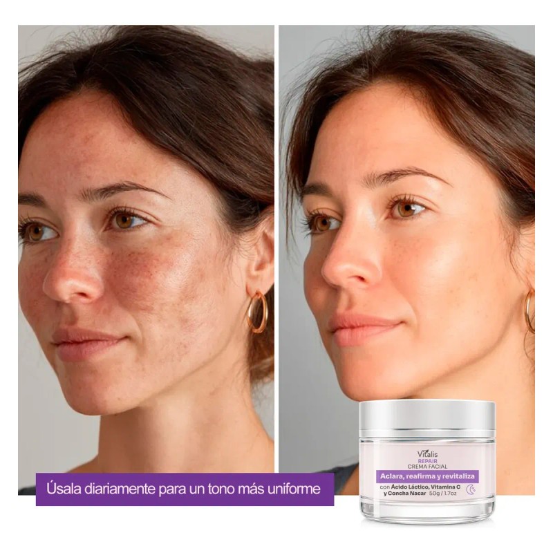 Crema Despigmentante Para Manchas, Melasma, Acné Y Paño 50g