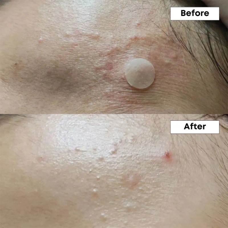 Nineless Sérum Facial Ácido Azelaico 10% Controla Imperfecciones y Brillo