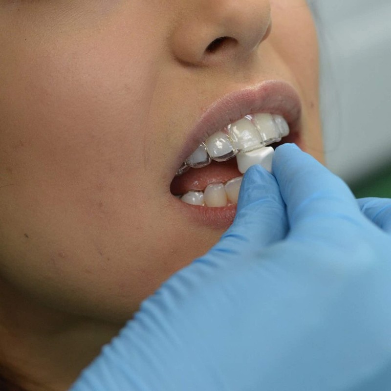 Movemints Clear Aligner Mints - Specially Designed for Clear Aligners