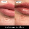 Lusabe Parches Para Acné Invisibles 36pzs Pimple Patch