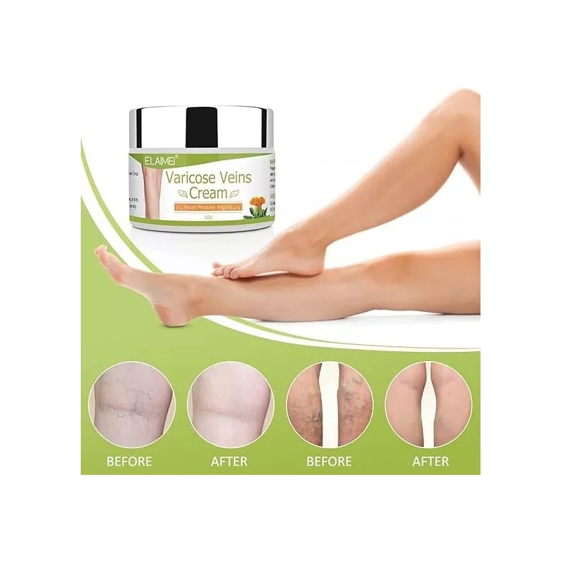 Purvigor Crema Para Eliminar Rápido Las Varices Y Arañitas Vasculares
