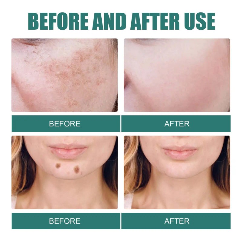 Crema Eliminadora De Pecas Y Blanqueamiento Hd Xifei