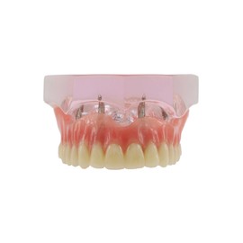 Dental Implant Teeth Demo Model Maxillary Overdenture with 4 Implants