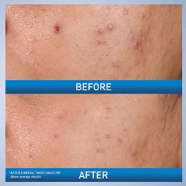 CeraVe Salicylic Acid Acne Treatment with Glycolic Acid and Lactic Acid | AHA/BHA Acne Gel for Face to Control and Clear Breakouts |1.35 Ounce