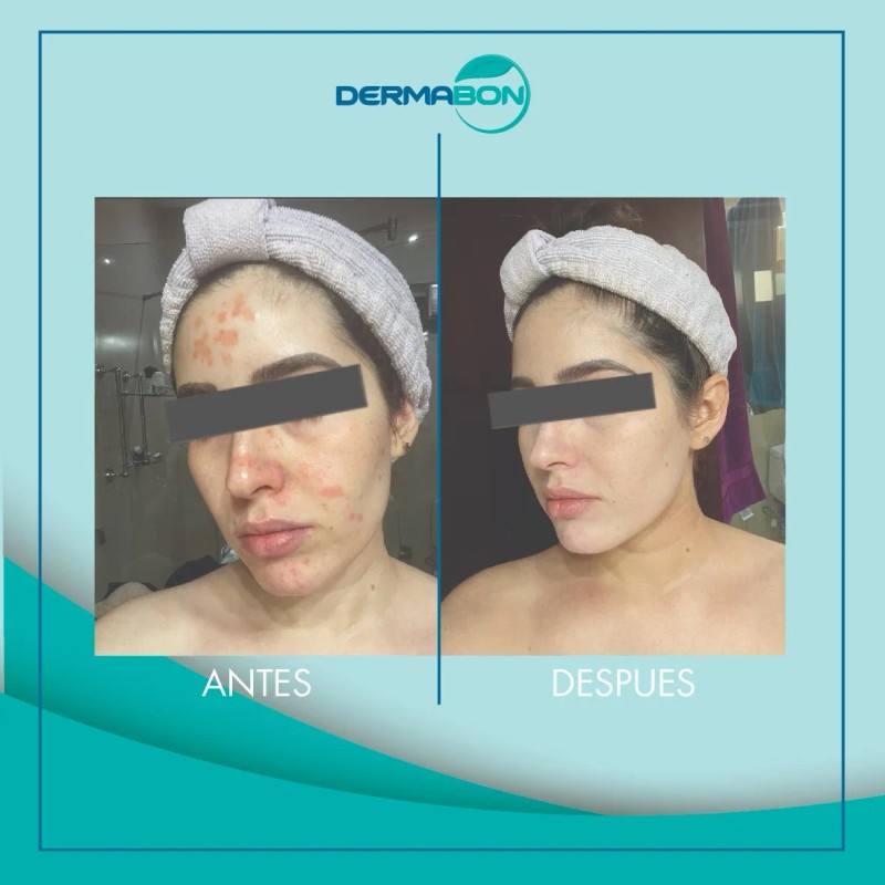 Jabón Dermabon Individual De 90 Gramos