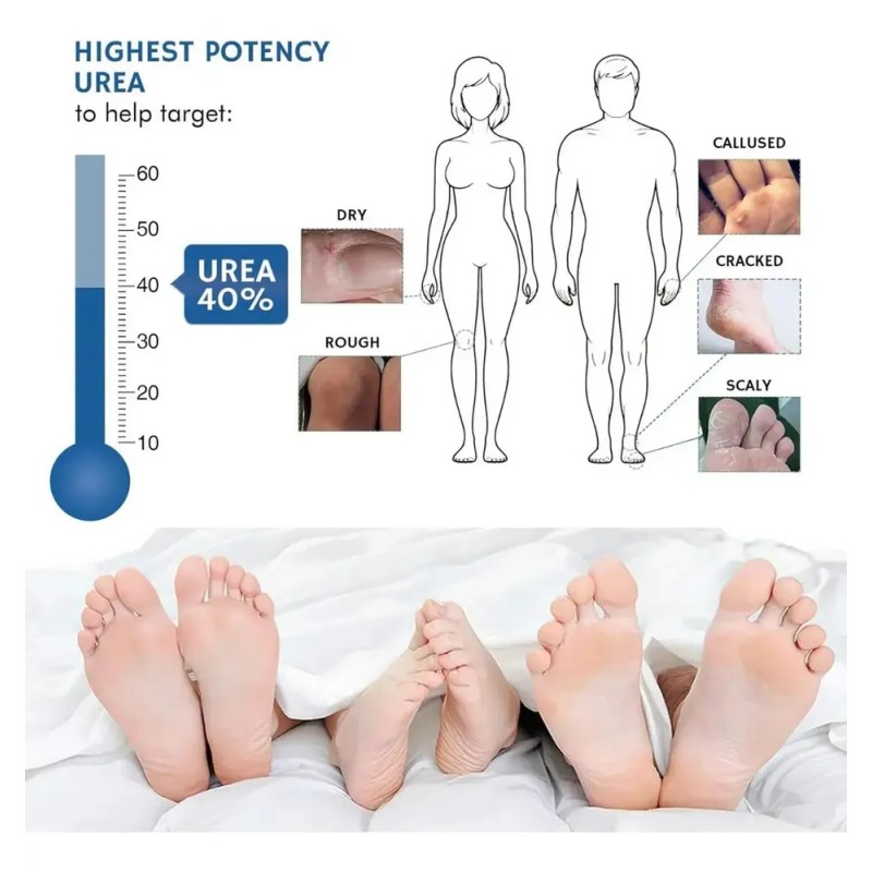 Crema De Urea Al 40 Por Ciento Para Pies, Crema