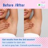 Alice. Pulsed Light Epilator Cooling Quartz Flash Hyper Powerful Painless