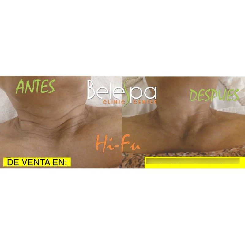 KEMETVOV Minihifu Facial Corporal+masajeado Cuello Papada Lifting+gel