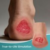 MedEduQuest Heel Pressure Injury Stages Model, Ulcer Demonstration Model