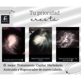 Solución Anticaida Para Hombre Con Cabello Con Caspa