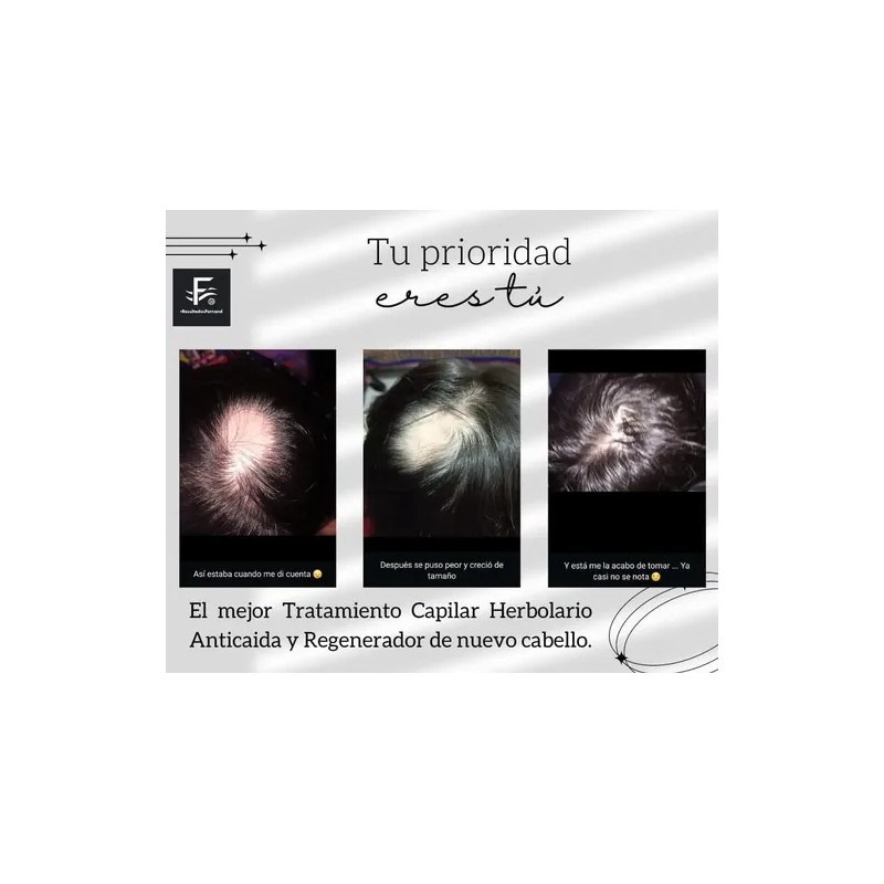 Solución Anticaida Para Hombre Con Cabello Con Caspa