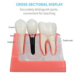 ANNWAN - Modelo de implante dental 4 veces extraíble análisis corona puente demostración modelo de dientes para educación de clase y estudio de dientes
