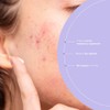 100% natural treatment of acne and reactive skin on the