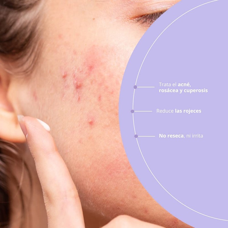 100% natural treatment of acne and reactive skin on the