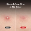 [MIZON] GOOD BYE BLEMISH CLEAR PATCH (x44) Korean Skincare -