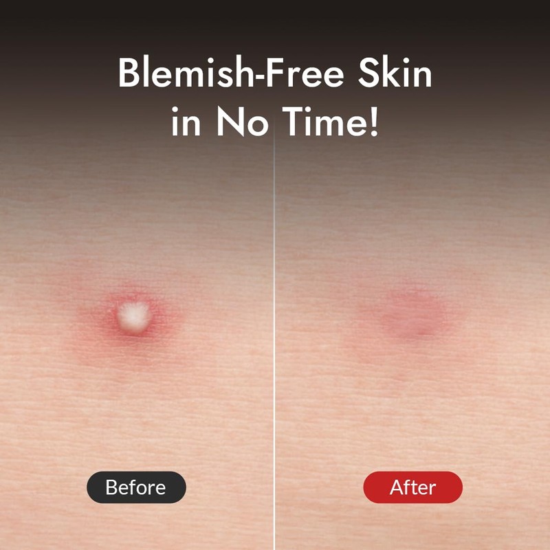 [MIZON] GOOD BYE BLEMISH CLEAR PATCH (x44) Korean Skincare -