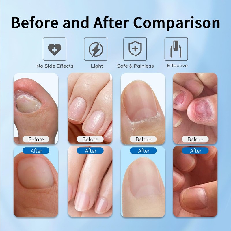 Nagel laser Gerät,Nagelhärter,Gerät zur Reinigung und Pflege der Nägel für