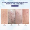 QUARXERY 3 in 1 Precisely Anti Acne Acne Spot Saviour
