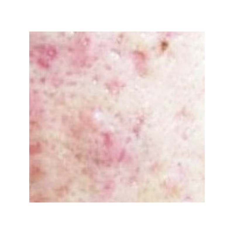 뾰루지짜기 등드름압출 초등학생코피지 볼블랙헤드 턱화이트헤드 Pimple Squeezing Back Acne Extraction