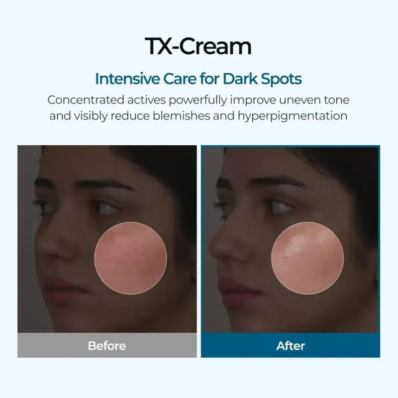 Q1 - Crema De Ácido Tranexámico Tx, Crema Antipecas, 1