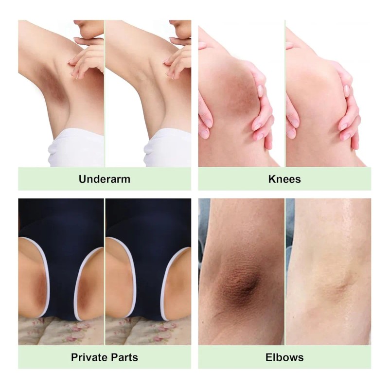 Crema Blanqueadora Para Aclarar La Piel De Las Zonas Íntimas