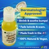 Urban ReLeaf Piercing Bump Shrinking Drops! Keloid Bumps Gentle Effective