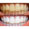 Teeth Whitening Kit