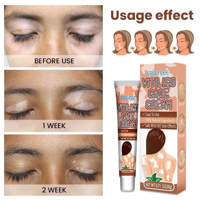 Vitiligo Cream, Natural Effective Vitiligo Treatment for Reduce White Spots