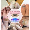 iKeener Nail Lamp &Nailfungus Light Treatment Device For Toenail &