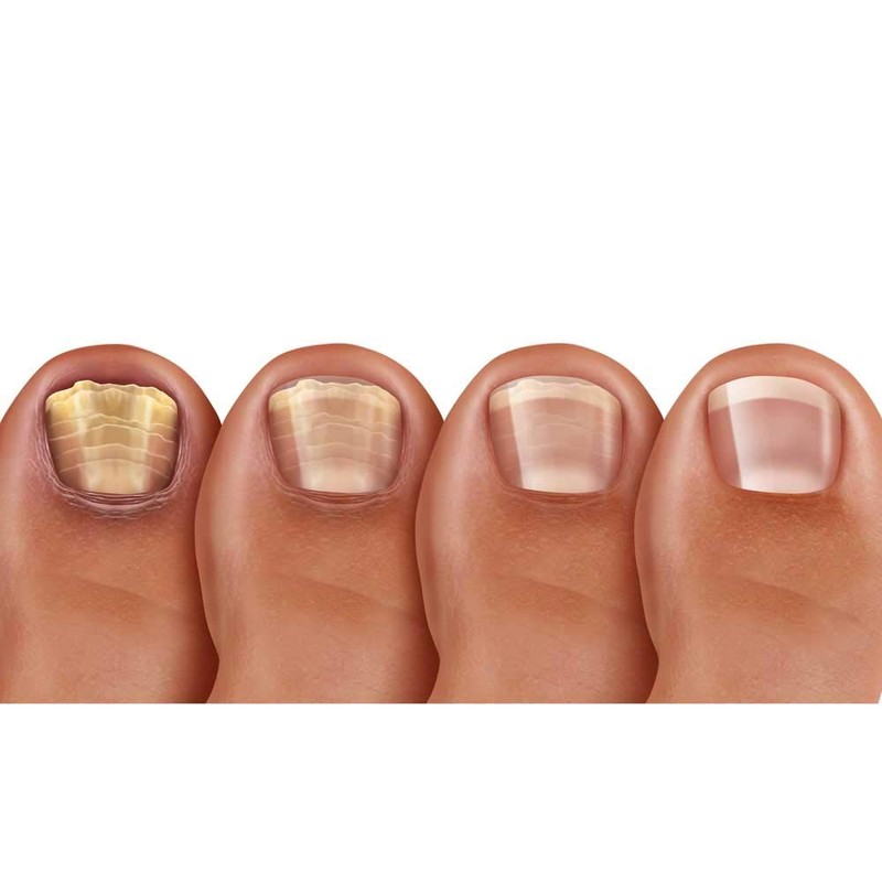 Pronail Plus Fungal Nail Solution 10 ml Brush Application