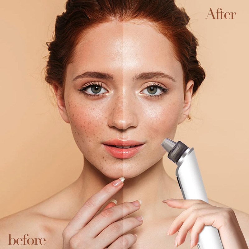 Blackhead Remover Black Head Remover for Face Whitehead Acne Remover