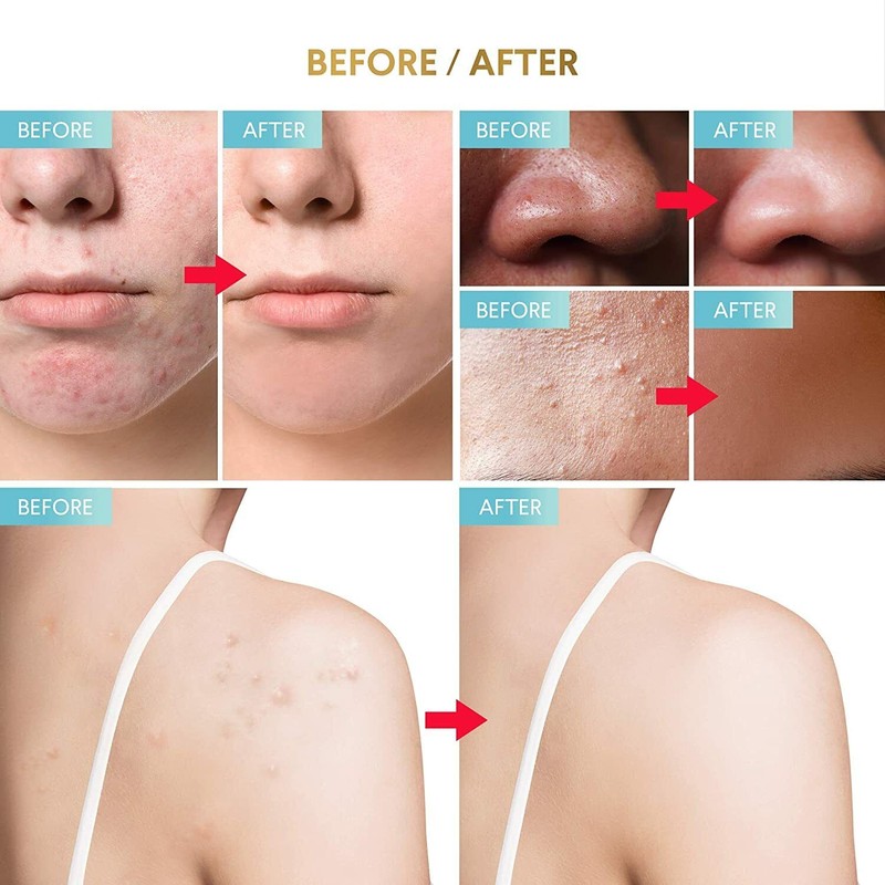 Glossiva Overnight Solution Drying Lotion, Acne & Blemish Treatments, 12/2025