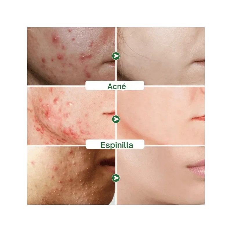 Tratamiento Para Eliminar Acné Espinillas Cicatrices De Acné