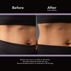 Kit Parche Gel Scaraway Elimina Cicatrice Reusables Queloide