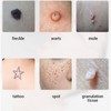 9 Modes Adjustable Tattoo Scar Spot Freckle Removal Pen Skin