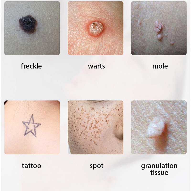 9 Modes Adjustable Tattoo Scar Spot Freckle Removal Pen Skin